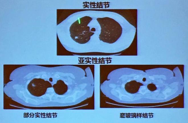 怎么简单的在上海看好肺结节